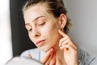 Guide to fighting acne in autumn: Say goodbye to dryness and greasiness, and regain stable muscle